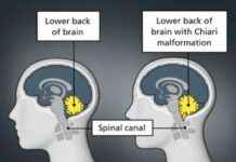 Successful Treatment of Childhood Brain Disease in 32-Year-Old Man at Mumbai Hospital news-02092024-125201