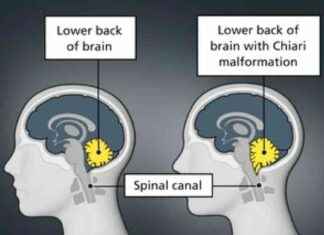 Successful Treatment of Childhood Brain Disease in 32-Year-Old Man at Mumbai Hospital news-02092024-125201