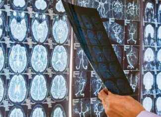 14 Risk Factors for Dementia: Lancet’s Comprehensive Guide news-21092024-120910