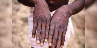 New advisory issued by government to states and UTs regarding Mpox Clade 1b case news-27092024-033312